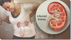 kidney-infection
